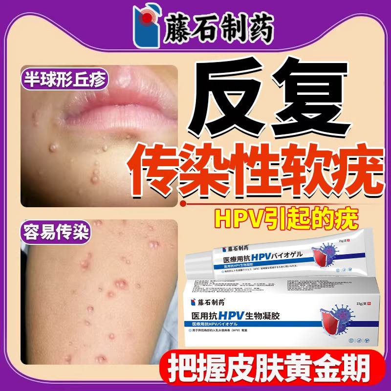 可搭配病毒性传刮染性软疣幼儿童医用镊子夹子勺水瘊子软尤药膏LJ