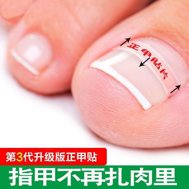 甲沟矫正器指甲矫正甲贴片纠正趾甲往肉里长嵌甲内嵌校正器修脚刀,家庭/个人清洁工具,美甲/修甲套装,淘宝优惠券,粉丝福利购,淘宝优惠卷