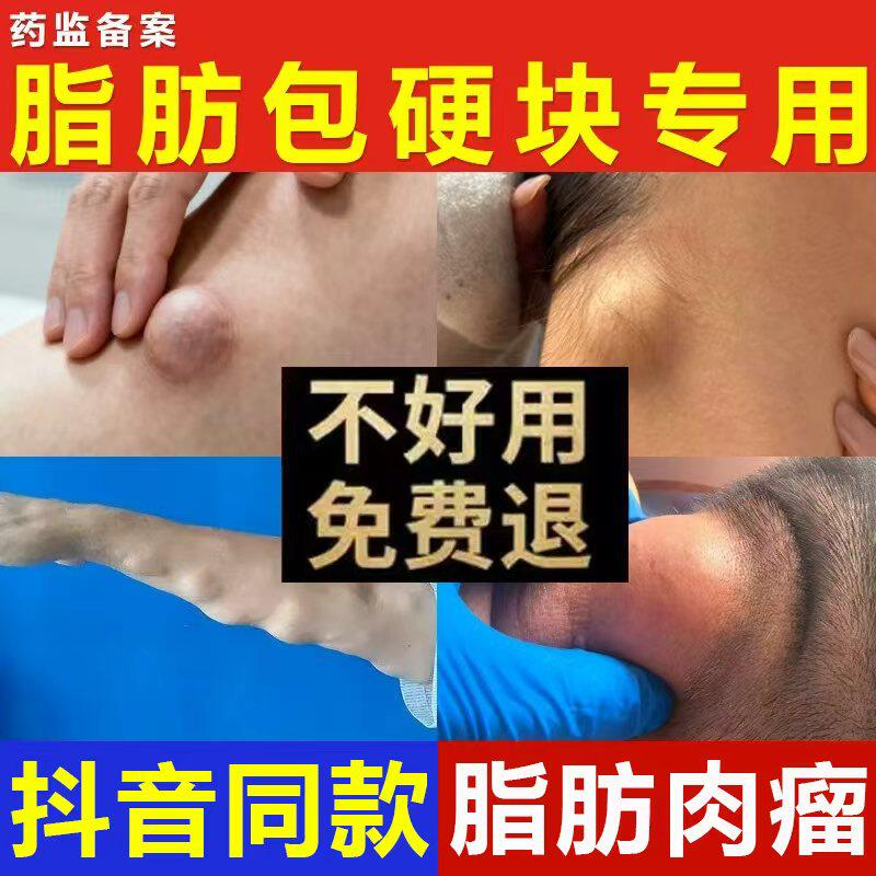 陈九玄医用聚乙二醇护创敷料顽固脂肪包硬块疙瘩皮下囊肿正品K5