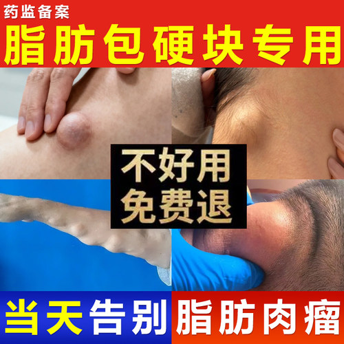 陈九玄医用聚乙二醇护创敷料顽固脂肪包硬块疙瘩皮下囊肿正品K5