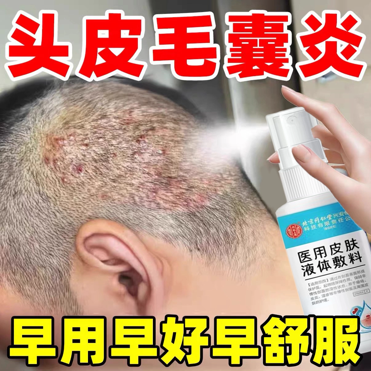 头皮毛囊炎效特膏药头部专用头上长痘痘痒有疙瘩脂溢性皮炎喷雾剂