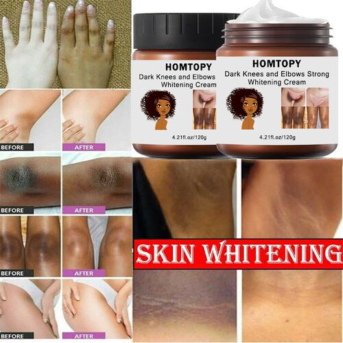 Dark Knees and Elbows Strong Whitening Cream
