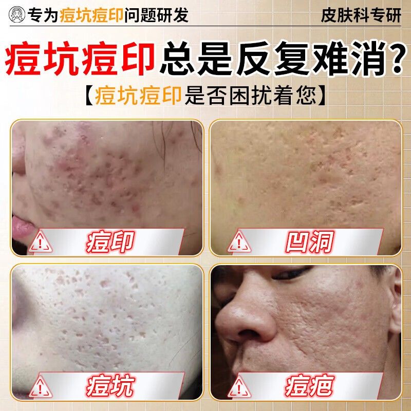 油共康痘痘印护理膏修复AOP凹洞淡化消填充坑再生祛疤黑控色素沉i