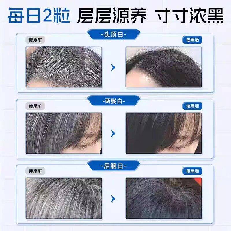 L-CAL维ORIE合维安生素d3白掉发XDJ维安复 维生素D3滋养发根发养