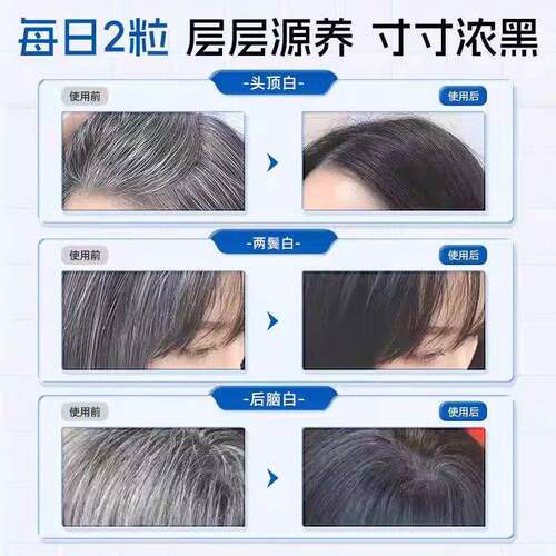 L-CAL维ORIE合维安生素d3白掉发XDJ维安复 维生素D3滋养发根发养