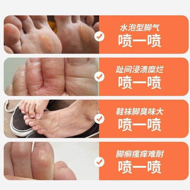 脚气SDI喷雾剂体验装儿童痒脱烂皮脚丫真菌感染痒止脚气喷脚剂