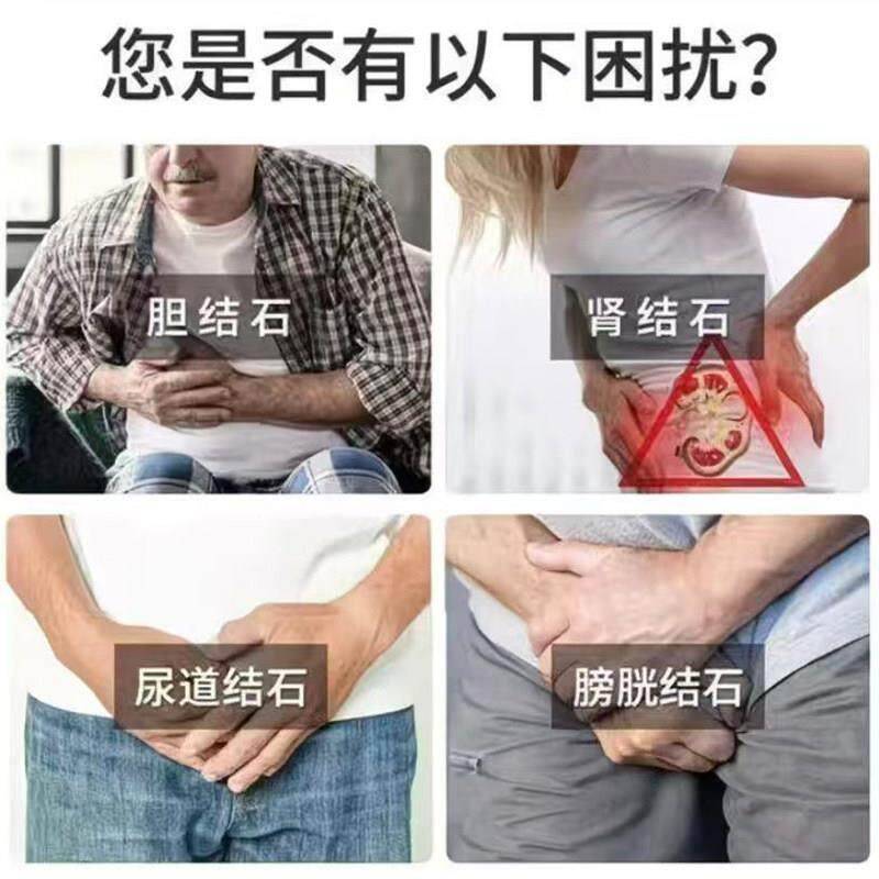 仲景金消石宝清石碎石石消胆结石利DNA尿排鸡内白茅根茯苓