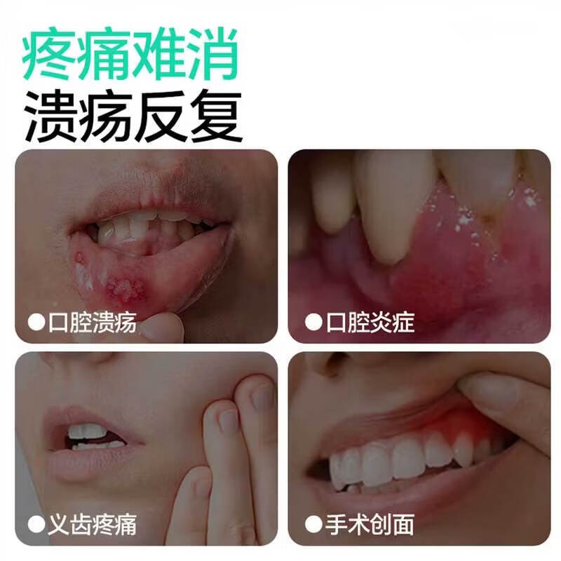 LMJ云南本草口腔溃疡上专用喷雾嘴巴火起泡发性口疮痛舌头剂复鹅