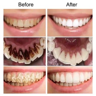 Teeth Whitening Serum Cleans Mouth Freshens Breath Essence