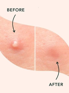 96Pcs/set Face Patch Hydrocolloid Acne Pimple Patches for