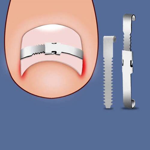 Professional Foot Care Correction Tool Ingrown Toenail Corre