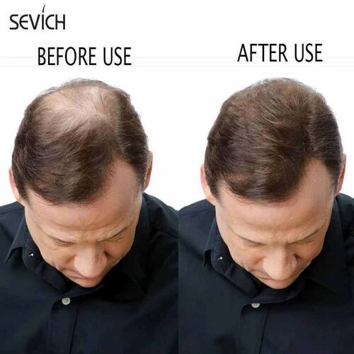 Sevich 500g Refill Hair Fiber Anti Hair Loss Product 10Color