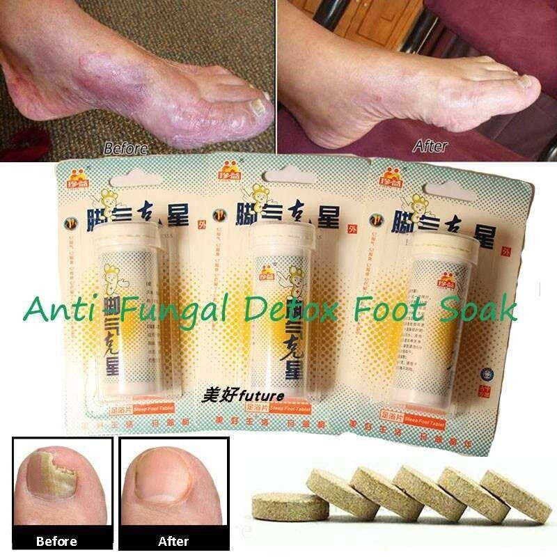 Foot Soak Cuticle Remover Skin Cracking,Psoriasis,Beriberi - 实物图