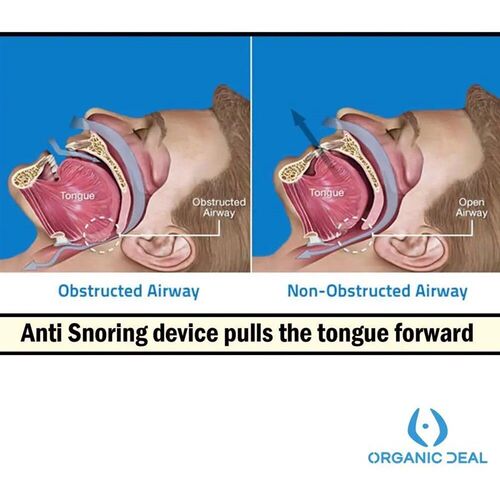 Anti Snoring Mouthpiece Tongue Retainer Helps to Eliminate S