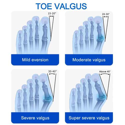 Bunion Splint Big Toe Straightener Hallux Valgus Correction