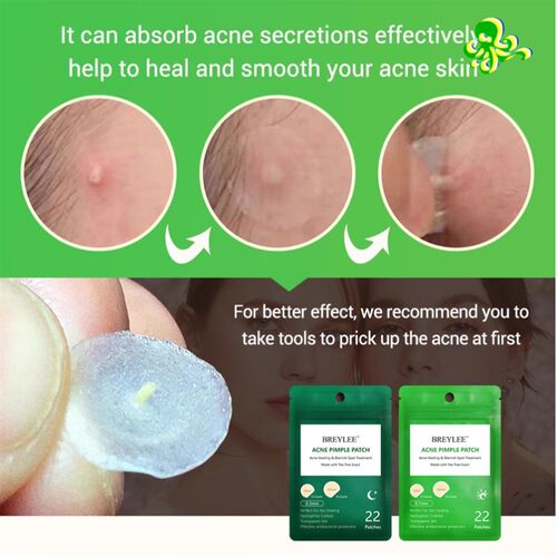Acne Pimple Patch  Stickers Acne Treatment Pimple Remover To