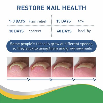 50pcs Ingrown Toenail Correction Tool Nail Correction Sticke