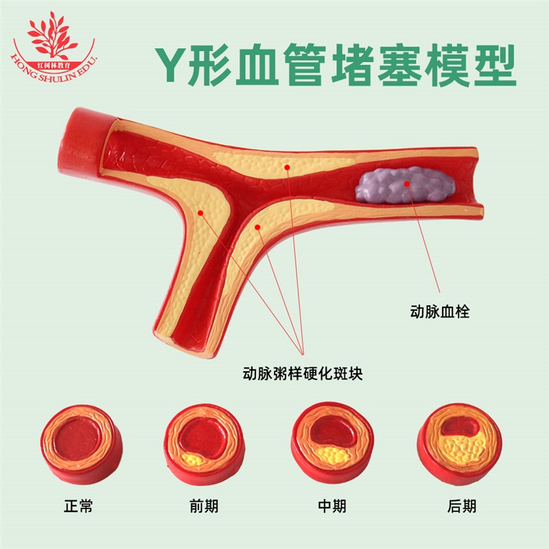 Y型血管堵塞模型医学心内科医患沟通冠状动脉粥样硬化血管模型