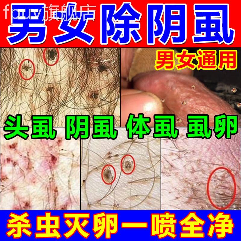 仓井昃川百部酊喷剂官方旗舰阴虱虱头虱体男女士私处外用成人正品