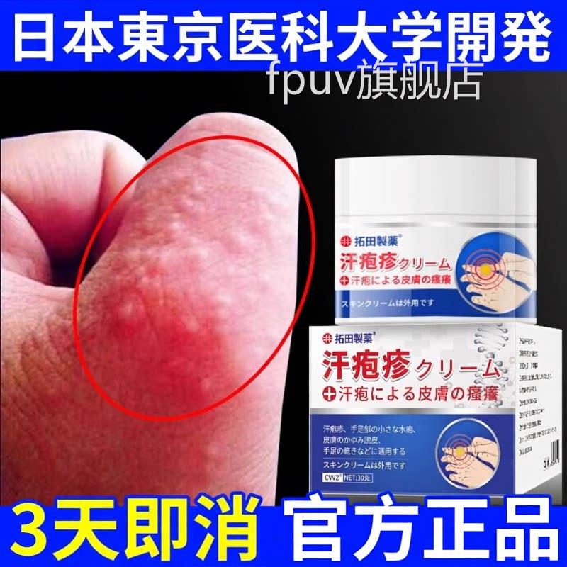 汗泡疱疹汗疱疹神汗状专软膏手上起小水泡器脱皮止痒非药膏根FPUV