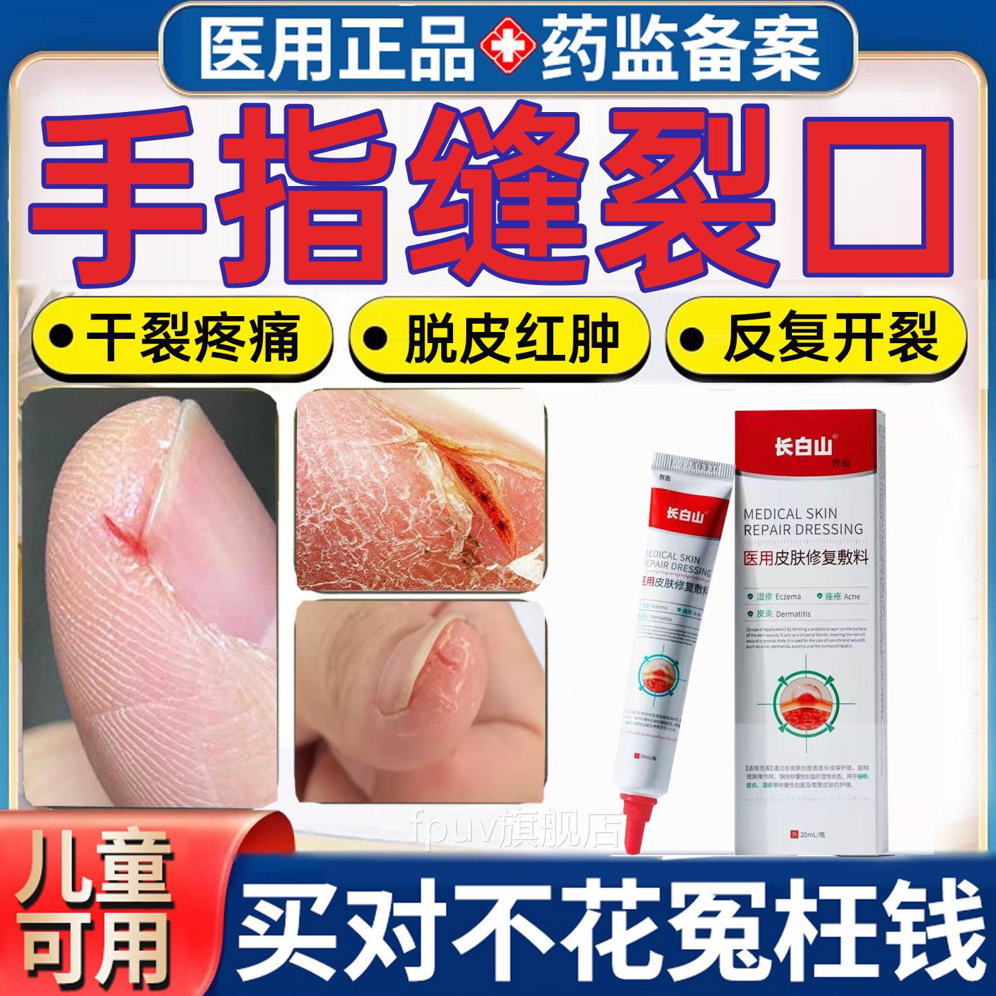 手指头裂口子脱皮开裂指甲缝干裂秋冬防裂脱皮膏手足裂季开皲裂MR