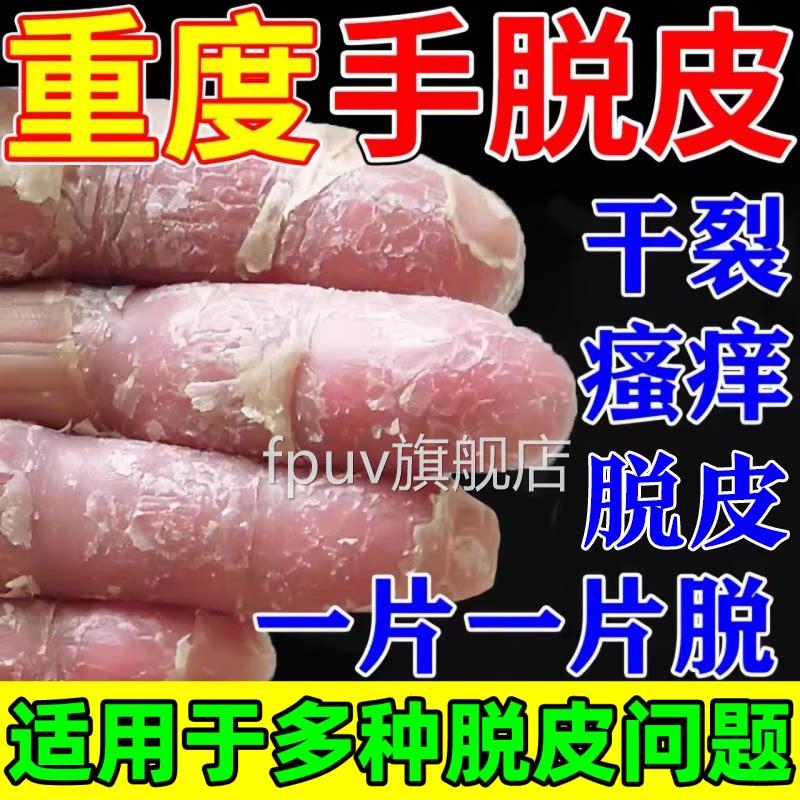 手足脱皮膏手用严重脱皮专真菌蜕皮干燥起皮感染季节性儿童手脱皮