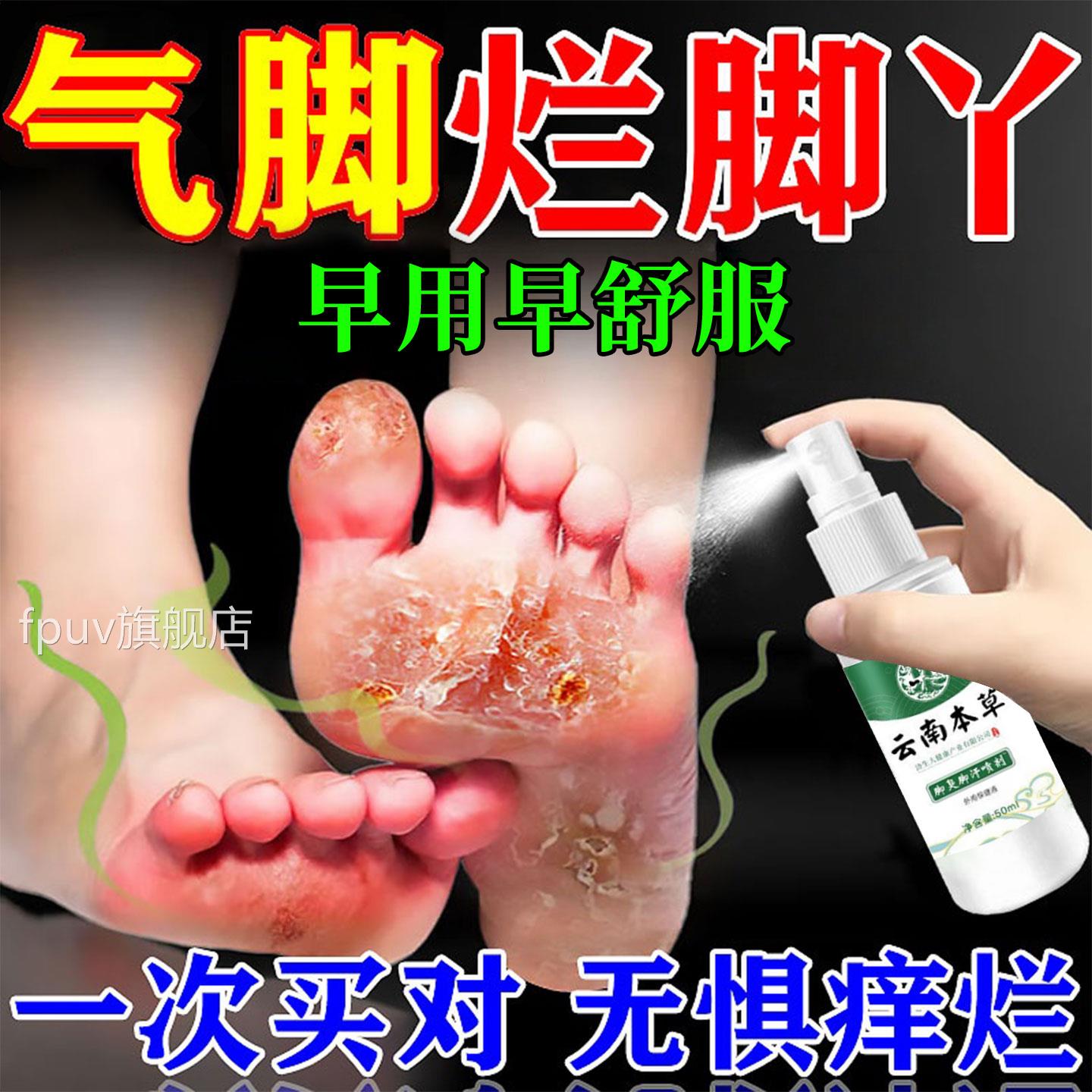 云南本草气脚喷剂烂止痒根脱皮抑菌水泡脚香港脚糜烂专脚趾缝痒用