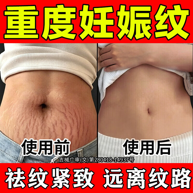 妊娠纹产后消除修复膏