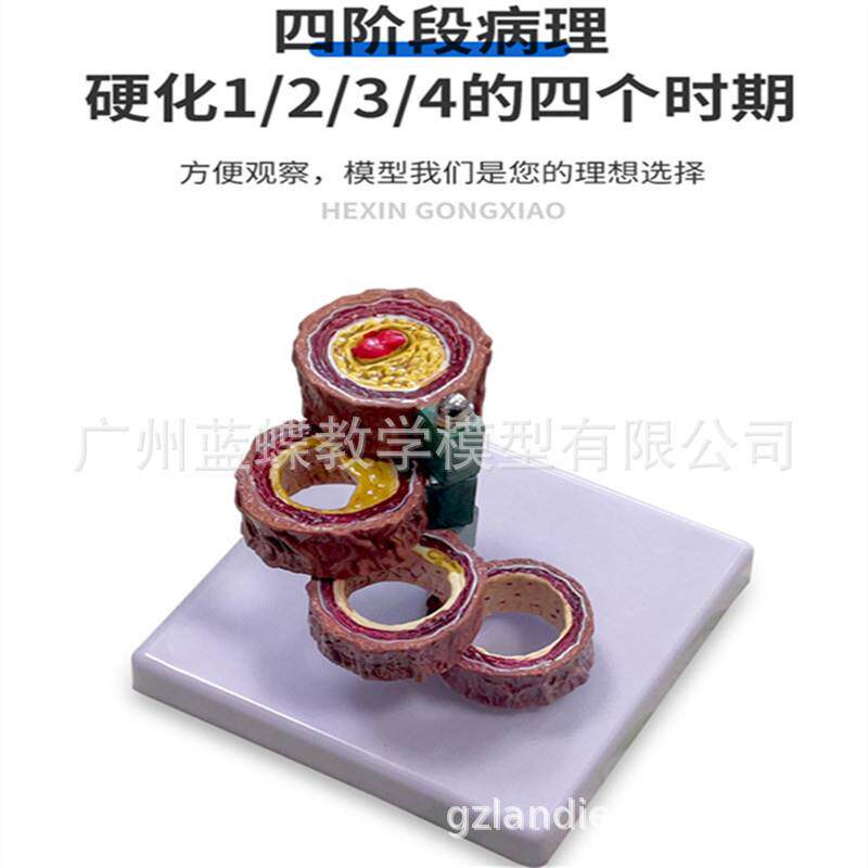 人体支脉粥样硬化 血栓 形成模型 血管模型 血液科 动脉 硬化模型 - 实物图