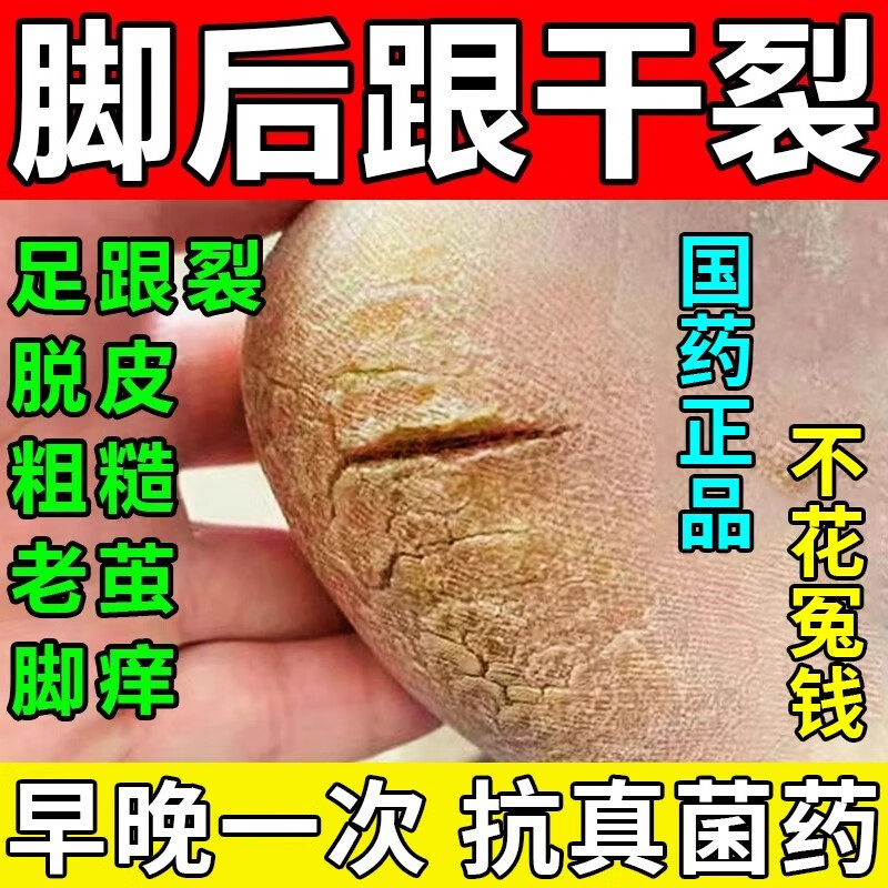 【福元】尿素维e乳膏1%15%*50g*1支/盒祛痘印补水止痒脚气脚气