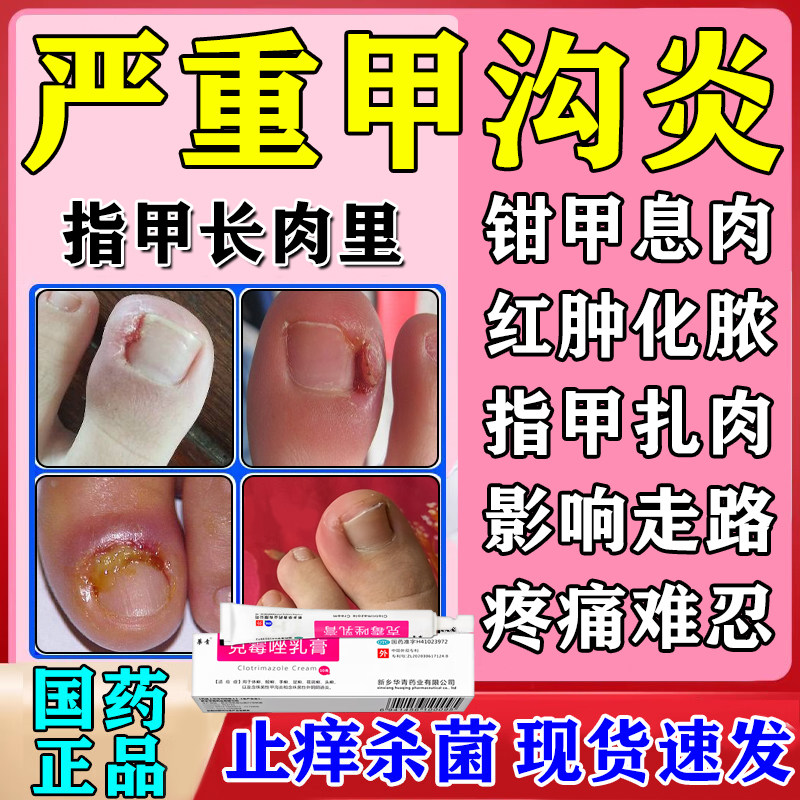 脚大拇手指甲沟炎治疗专用药麻甲沟炎软化趾甲根特药效克霉唑乳膏