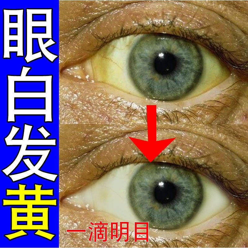 治眼白发黄红血丝眼干模糊清澈去黄滴眼液眼球发黄眼底玻璃体浑浊