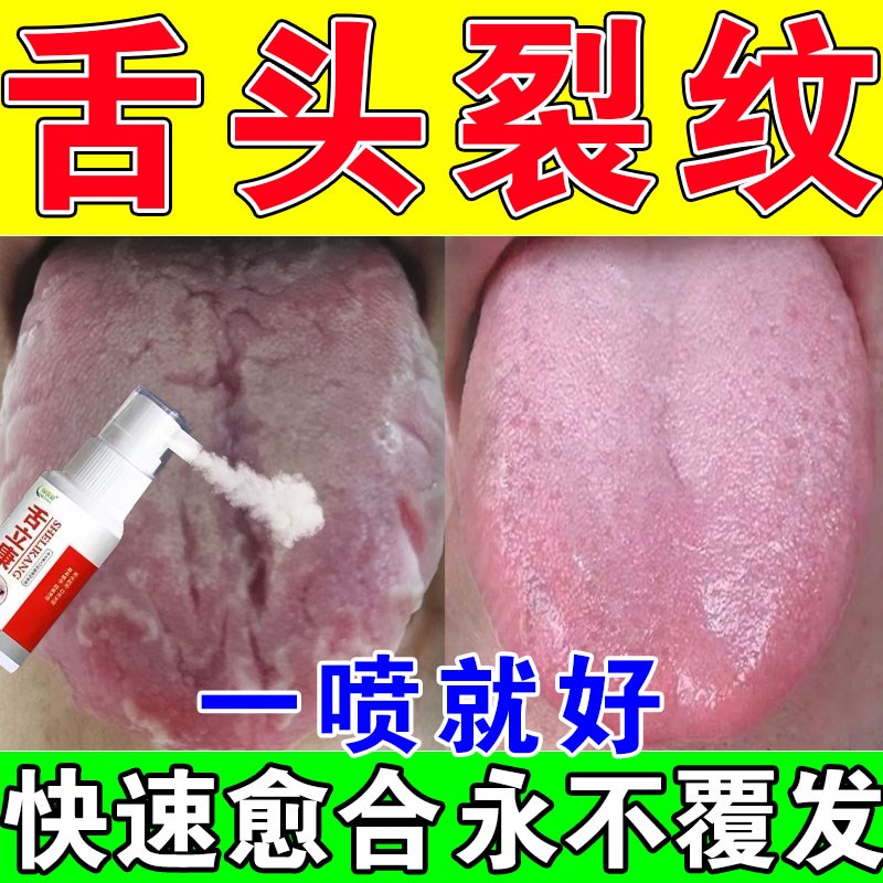 舌头裂痕地图舌齿痕舌调理灼口综合症裂纹有齿痕舌苔白厚治烂嘴药