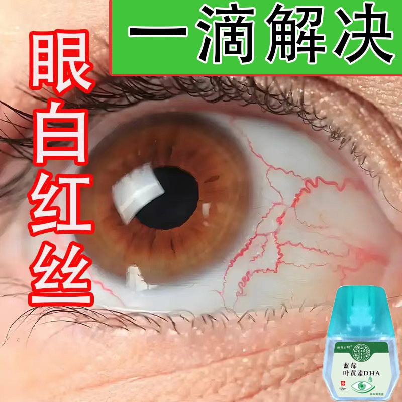 眼睛红血丝眼疲劳干涩眼痒结膜眼球酸胀刺疼模糊不清