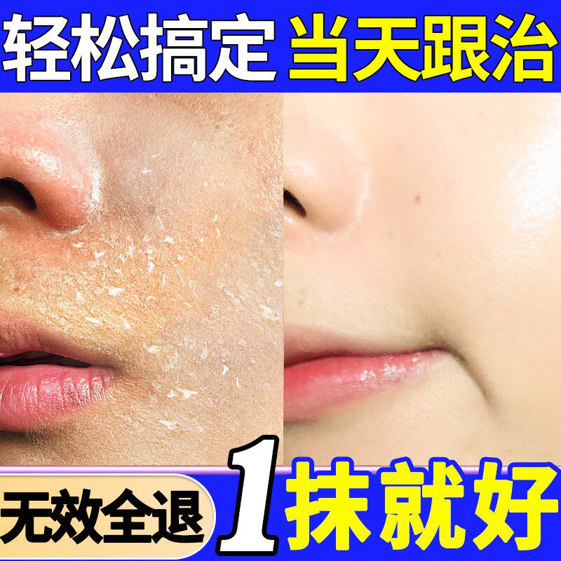 脸皮肤干燥起皮保湿补水脸上掉脱皮秋冬红痒开裂脸干男女爆皮修复