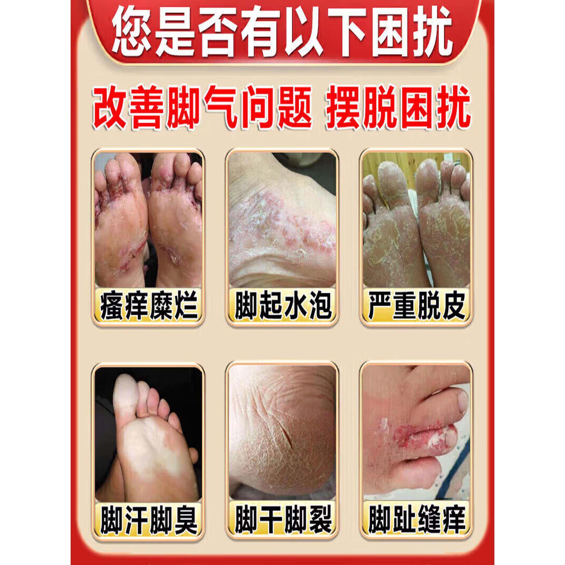 脚气喷雾止脱皮痒杀菌去真菌感汗染专用特根糜烂脚丫趾缝除臭出hw