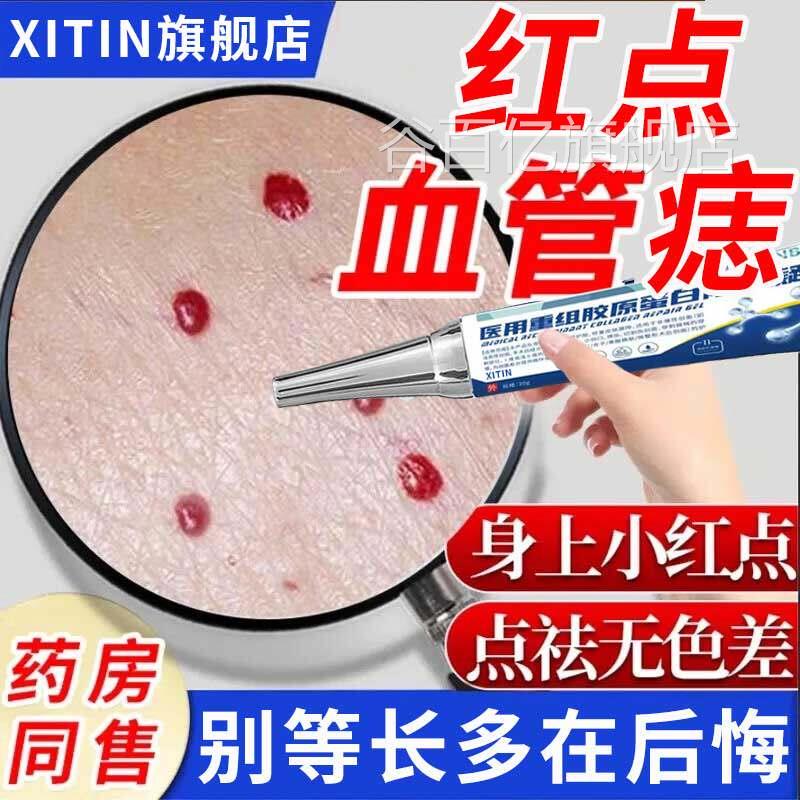 祛除红点血管管痣樱桃状血瘤蜘蛛痣疣点痣祛血痣黑疙瘩无痕凝胶ZT