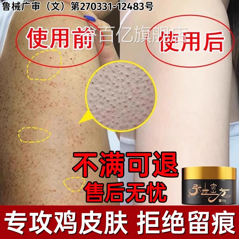 鸡皮肤疙瘩毛囊去角化症专用膏除神器全身手臂腿改善胳膊上长疙瘩