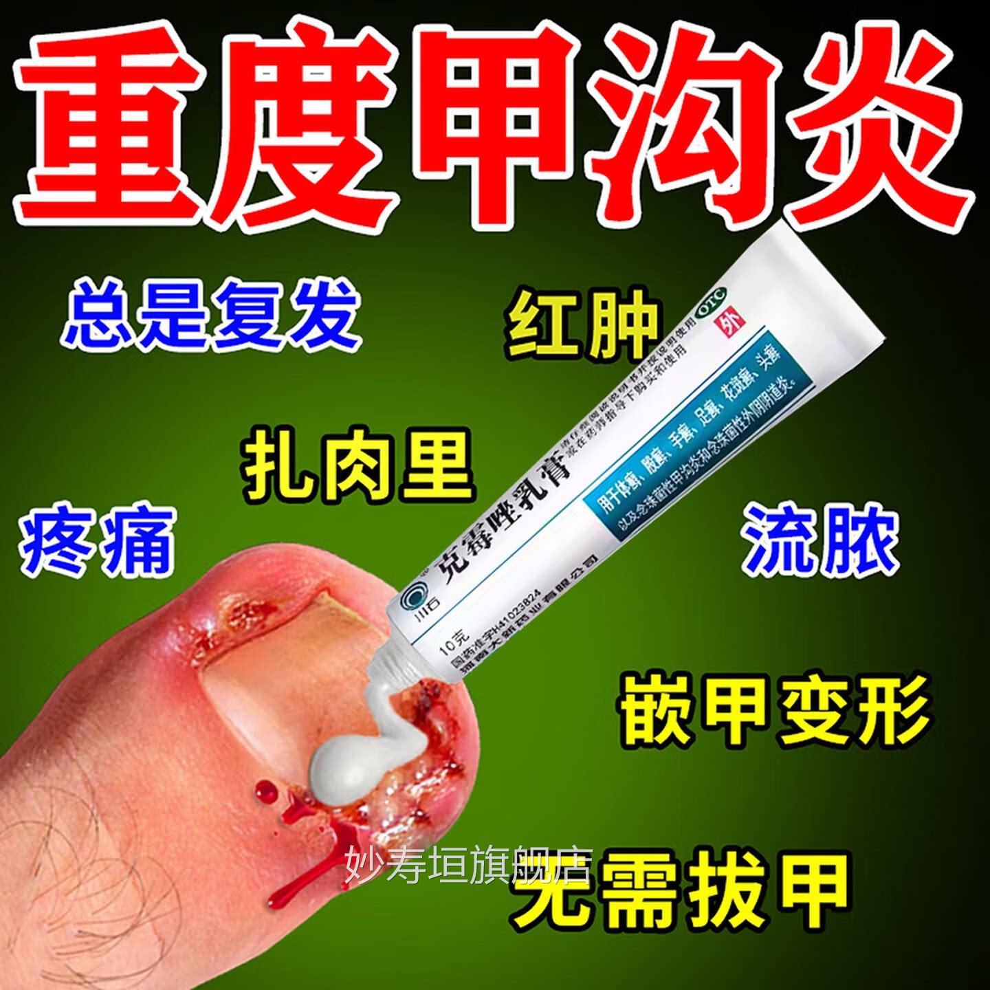 手脚大拇指沟炎治疗专用药膏水息肉去除脚甲趾甲往肉里长非特效QF