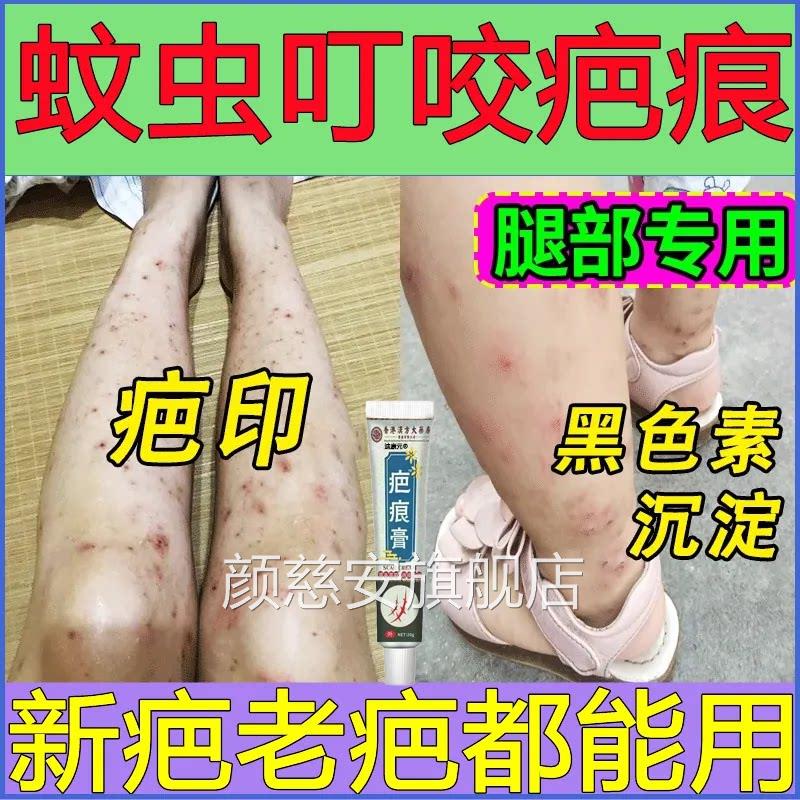香港疤痕膏新旧疤黑印增生虫叮咬包淡黑印修复疙瘩摔蚊伤结黑痂印
