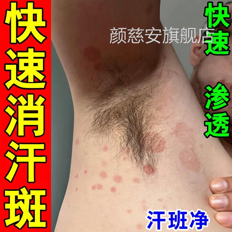 汗斑净喷剂花斑专治褐色斑后背用去白腋下汉斑痒膏医用级止颜慈安