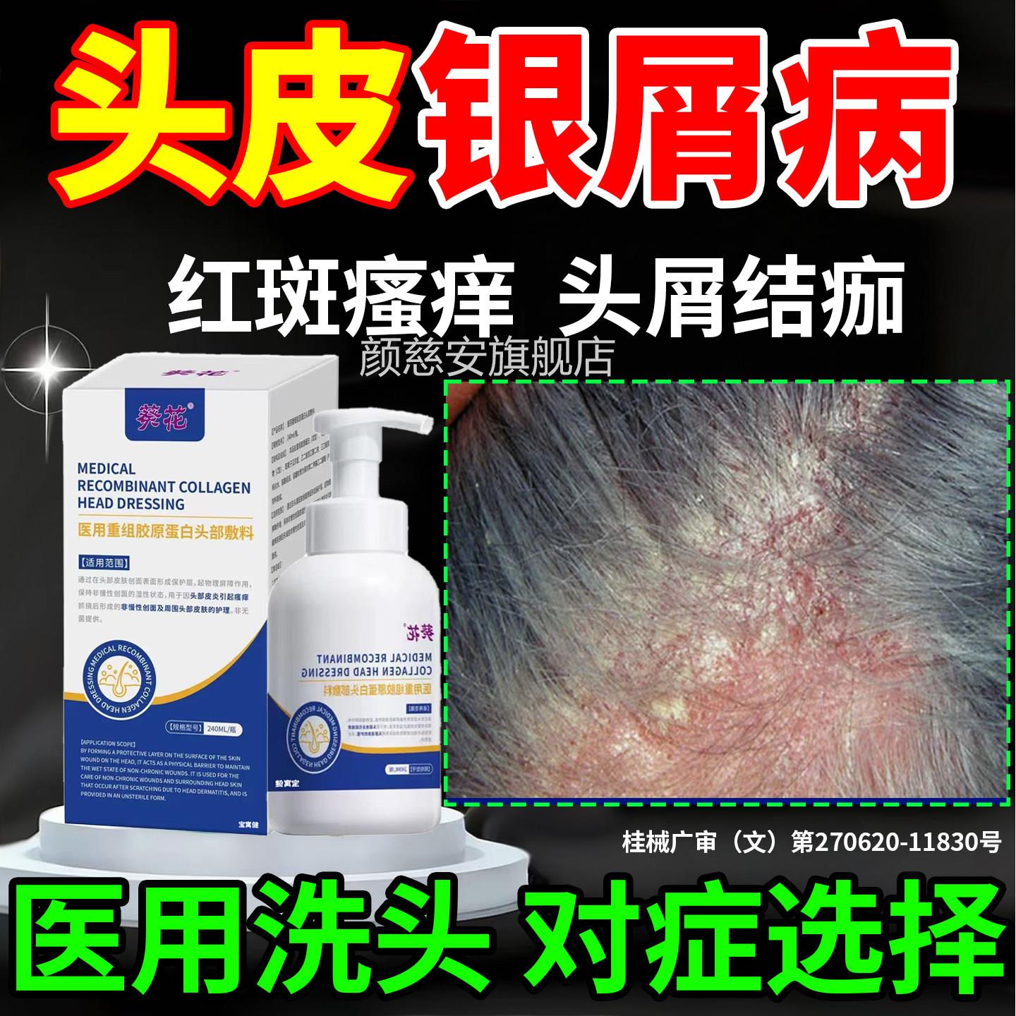 医瘙头皮银屑病专用洗头发部牛皮癣藓鲜膏药头癣头屑痒水真菌感染
