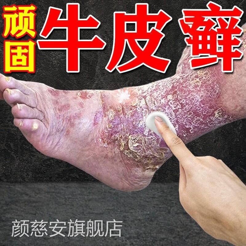 本日进口疗顽固性牛皮银屑效用膏药皮肤真菌感染杀菌颜慈安旗舰店