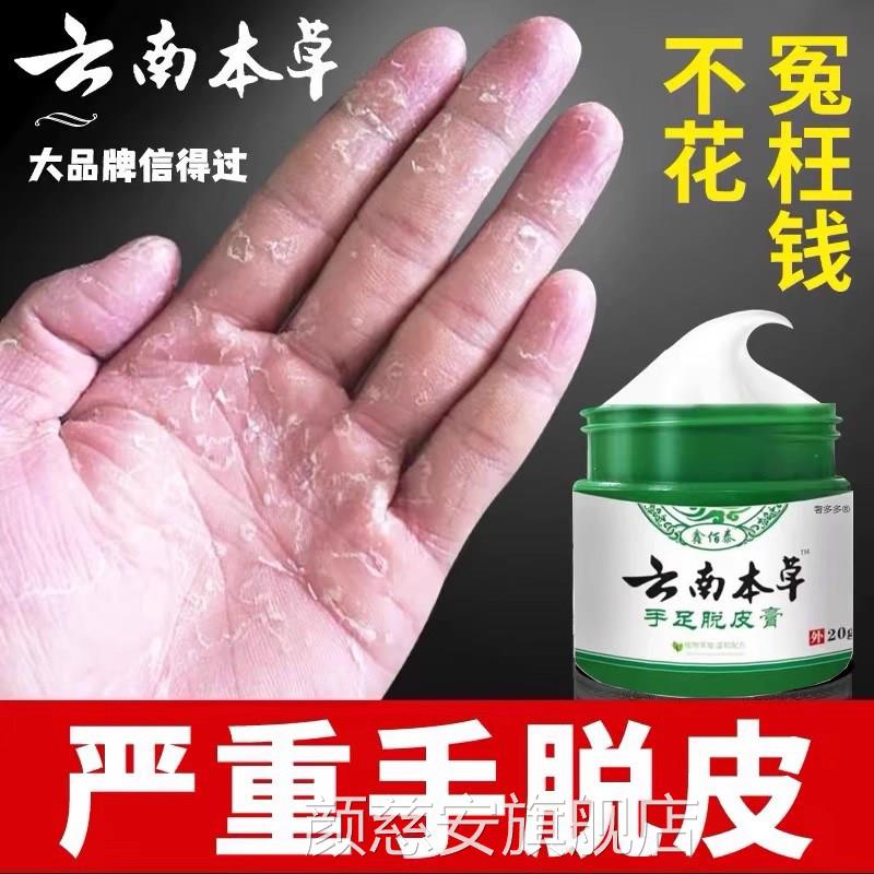 手足脱皮膏指上真菌蜕皮干手燥起皮童手掌蜕皮手心手足掉皮褪专用