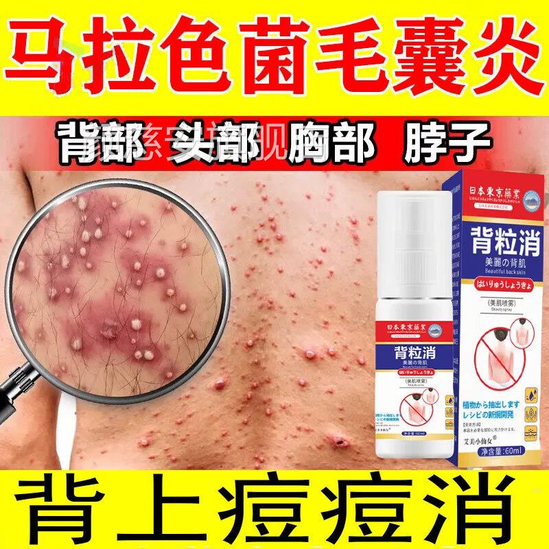 日本背粒消后祛痘马拉色菌毛囊炎特药前胸除螨虫粉刺抑菌背止痒颜