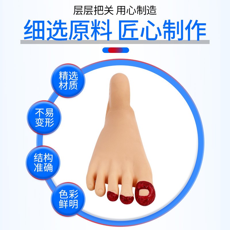 高级糖尿/病足护理模型 w足部病理变化模型 脚趾感染示教教具