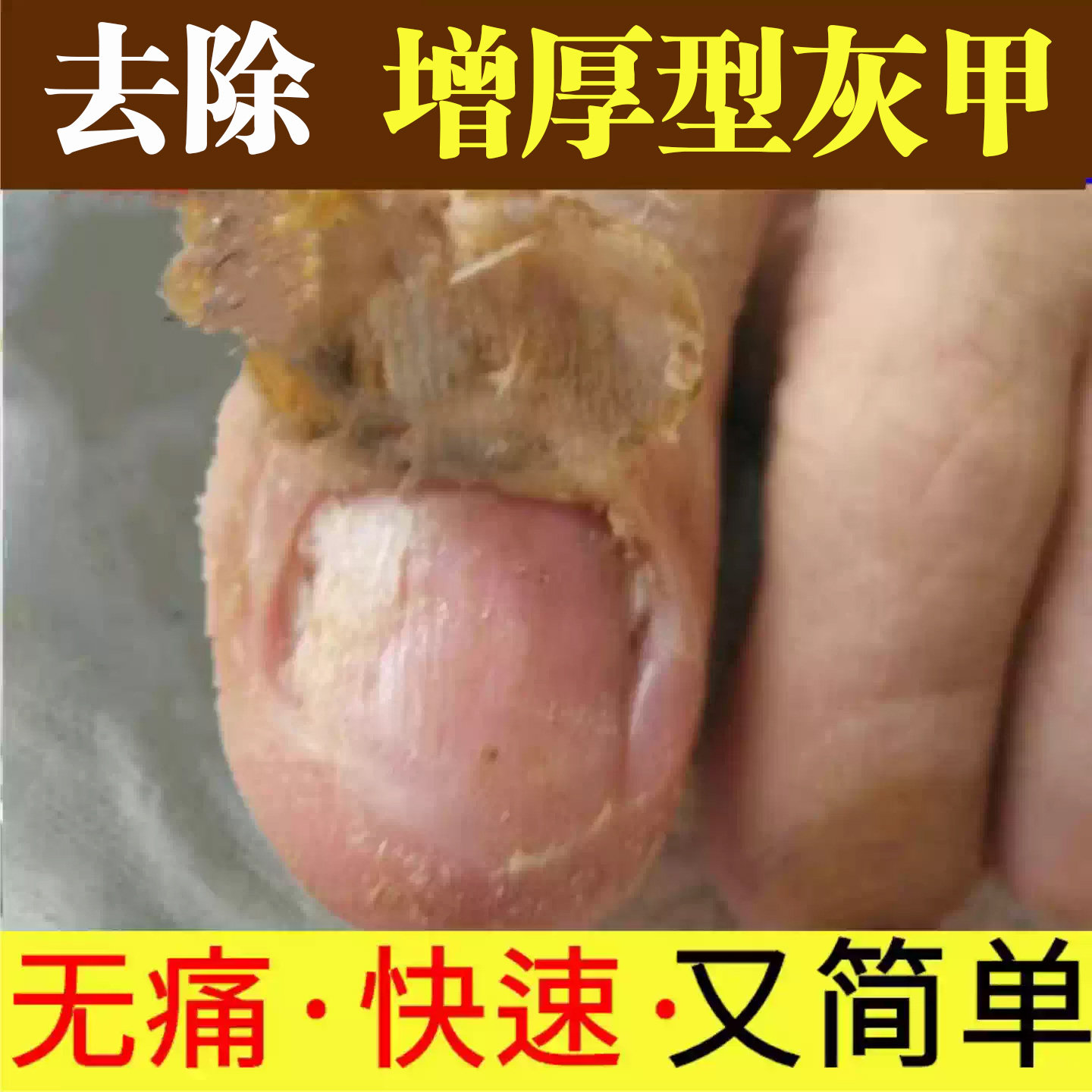 灰指甲脱甲膏专用修复液去除增厚趾甲护理盒抑菌液正品官方旗舰店