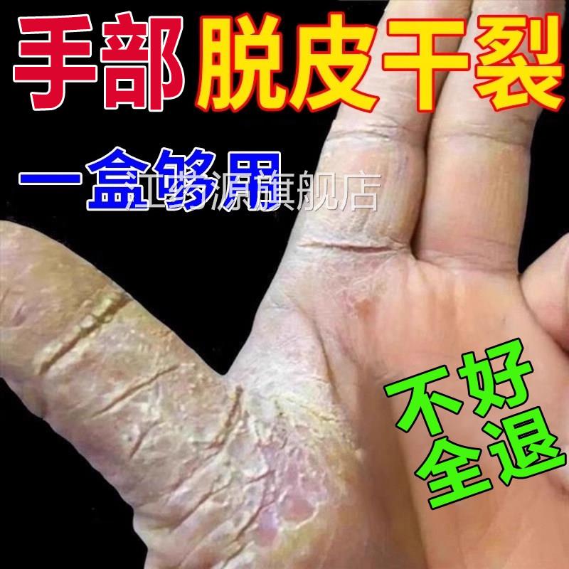 毒癣康膏脱皮足干裂真菌感染手癣专药监备案去湿疹止痒根皮肤病th