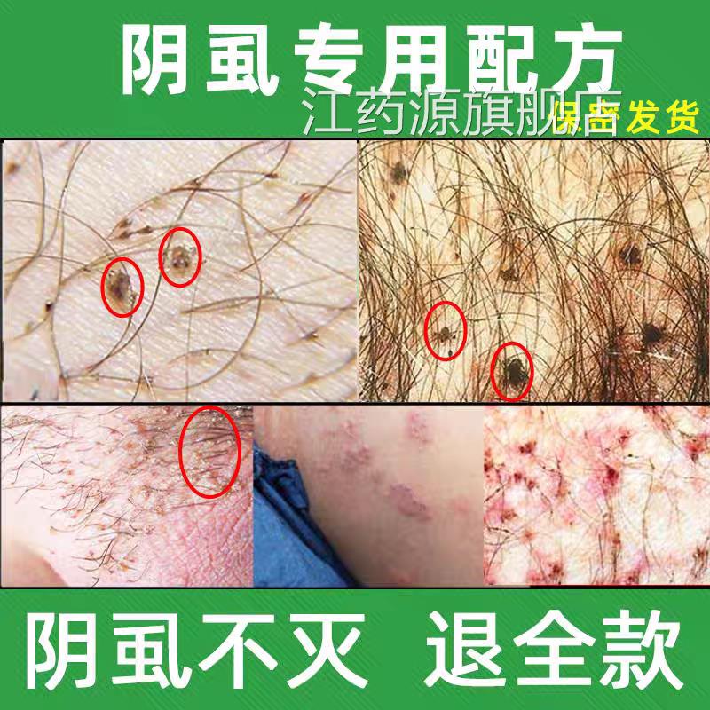 阴虱专用药一扫光正品子旗舰店敌百虫片人用虱阴毛虫治阴虱药喷剂
