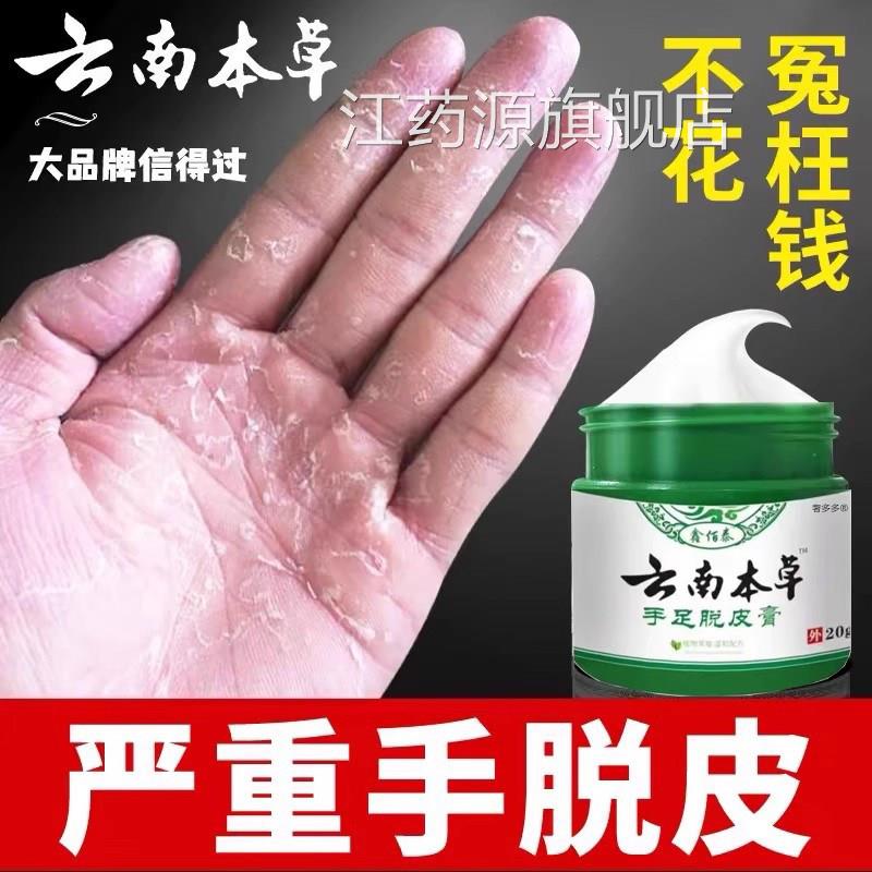 手足脱膏皮手指上真菌蜕皮干燥起皮童手掌蜕皮手心手足掉皮褪专用